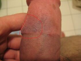 Hematoma due to improper use of a pump on the penis